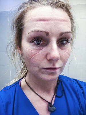 Gesichter der Krise: Das Gesicht einer Krankenhaus-Mitarbeiterin ist gezeichnet von schützendem Equipment