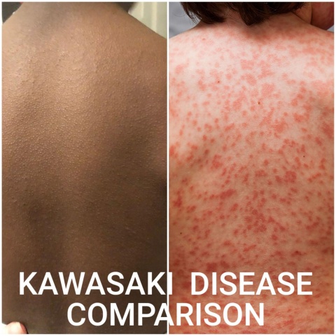 Die Kawasaki-Krankheit: Auf schwarzer Haut sieht der typische Ausschlag ganz anders aus als auf weißer. Ein Foto stellt die beiden Krankheiten und ihre visuelle Ausprägung gegenüber.